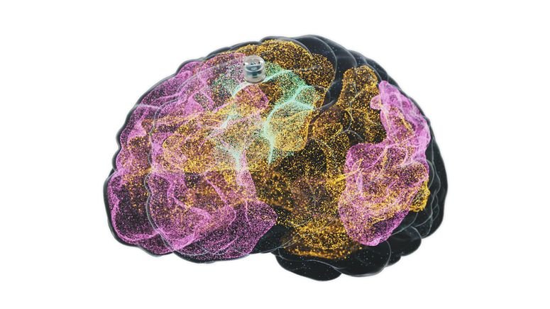 El dispositivo estimulador de Motif, del tamaño de un arándano, está diseñado para "activar" la red ejecutiva central del cerebro, que se encuentra poco activa en pacientes con depresión.