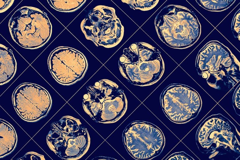Concepto de un escaneo cerebral para identificar demencia.