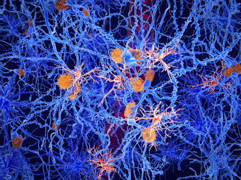 Concepto sobre cómo las células inmunitarias del cerebro se agrupan alrededor de las placas beta amiloides, relacionadas con la enfermedad de Alzheimer.