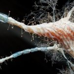 La radiación que se asocia con el cáncer ahora se relaciona también con el Alzheimer